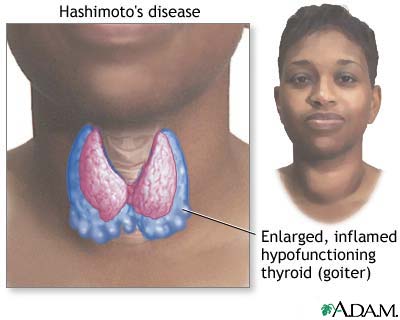 Hashimoto's disease (chronic thyroiditis)