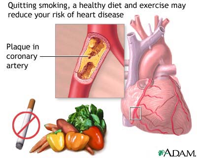 Prevention of heart disease