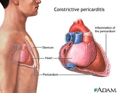 Constrictive pericarditis