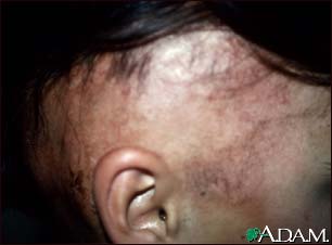 Alopecia, under treatment