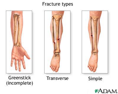 Fracture types (2)