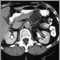 Pancreatic, cystic adenoma - CT scan