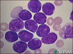 Acute lymphocytic leukemia - photomicrograph