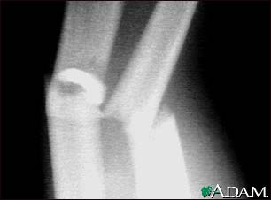 Fracture, forearm - X-ray