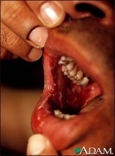 Pemphigus, vulgaris - lesions in the mouth