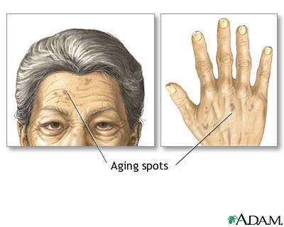 Aging spots