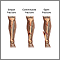 Bone fracture repair  - series