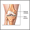 Knee joint replacement - series