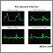Post myocardial infarction ECG wave tracings