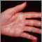 Herpes zoster (shingles) on the hand