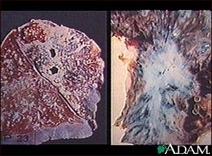 Tuberculosis in the lung