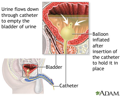 Bladder catheterization, male