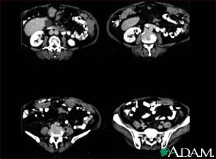 Peritoneal and ovarian cancer, CT scan