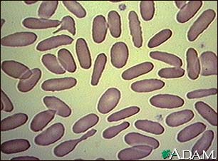 Red blood cells, elliptocytosis