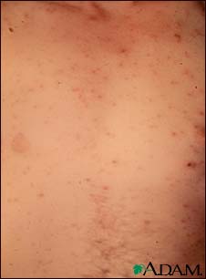 Chickenpox - lesions on the chest