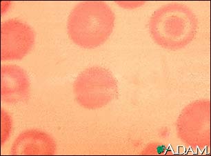 Red blood cells, target cells