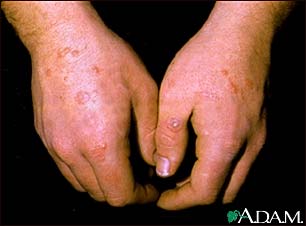 Erythema multiforme on the hands