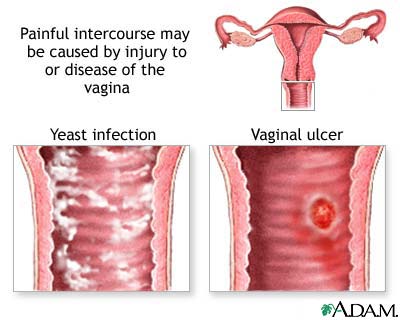 Causes of painful intercourse