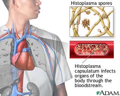 Disseminated histoplasmosis