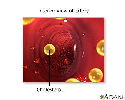 Blockage in internal carotid artery