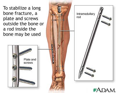 Internal fixation devices
