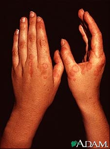 Erythema multiforme, circular lesions - hands