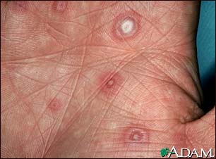 Erythema multiforme, target lesions on the palm