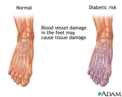 Diabetic blood circulation in foot