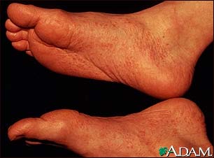 Reiter's syndrome - view of the feet