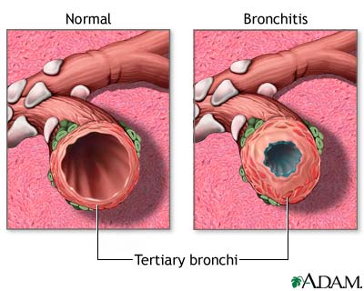 Bronchitis and Normal Condition in Tertiary Bronchus