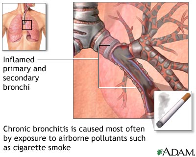 Cause of chronic bronchitis