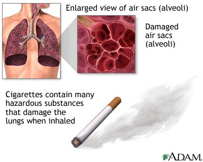 Smoking and COPD (Chronic Obstructive Pulmonary Disorder)