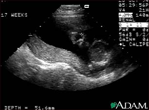 Ultrasound, normal relaxed placenta