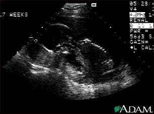Ultrasound, normal fetus - profile view