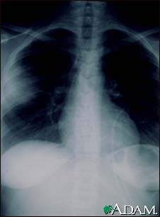 Aspergillosis - chest X-ray