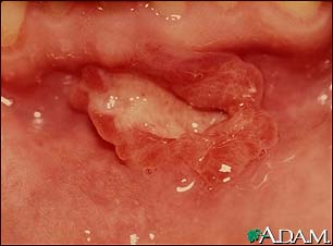 Canker sore (aphthous ulcer)