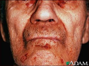 Amyloidosis on the face
