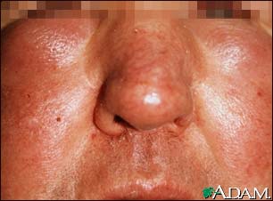 Edema, central on the face