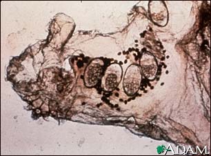 Scabies mite, eggs, and stool photomicrograph