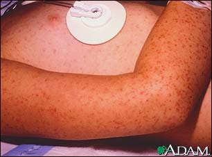 Rocky mountain spotted fever, petechial rash
