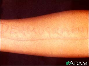Dermatographism - arm