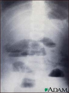 Small bowel obstruction - X-ray