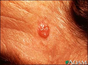 Basal Cell Carcinoma - face