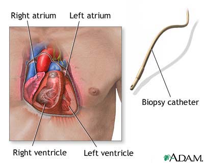 Biopsy catheter