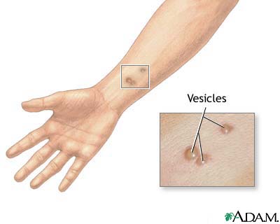 Vesicles