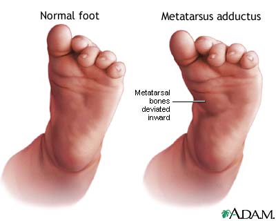 Metatarsus adductus