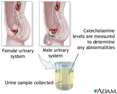 Catecholamine urine test