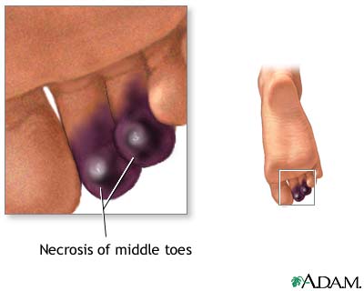 Necrosis of the toes