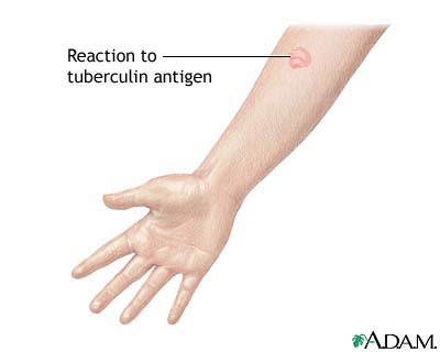 Tuberculin skin test