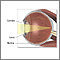 Radial keratotomy for myopia  - series